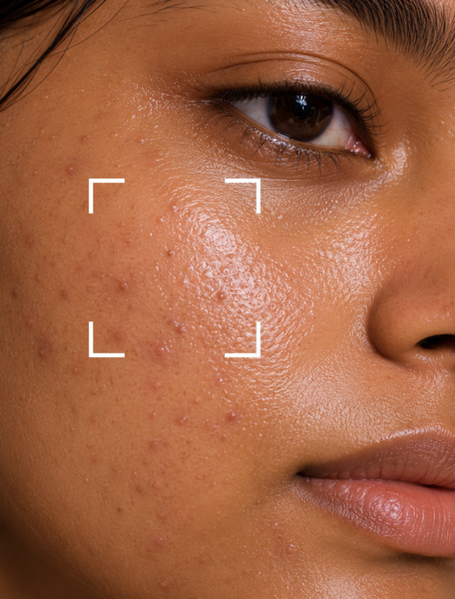 Oily Skin