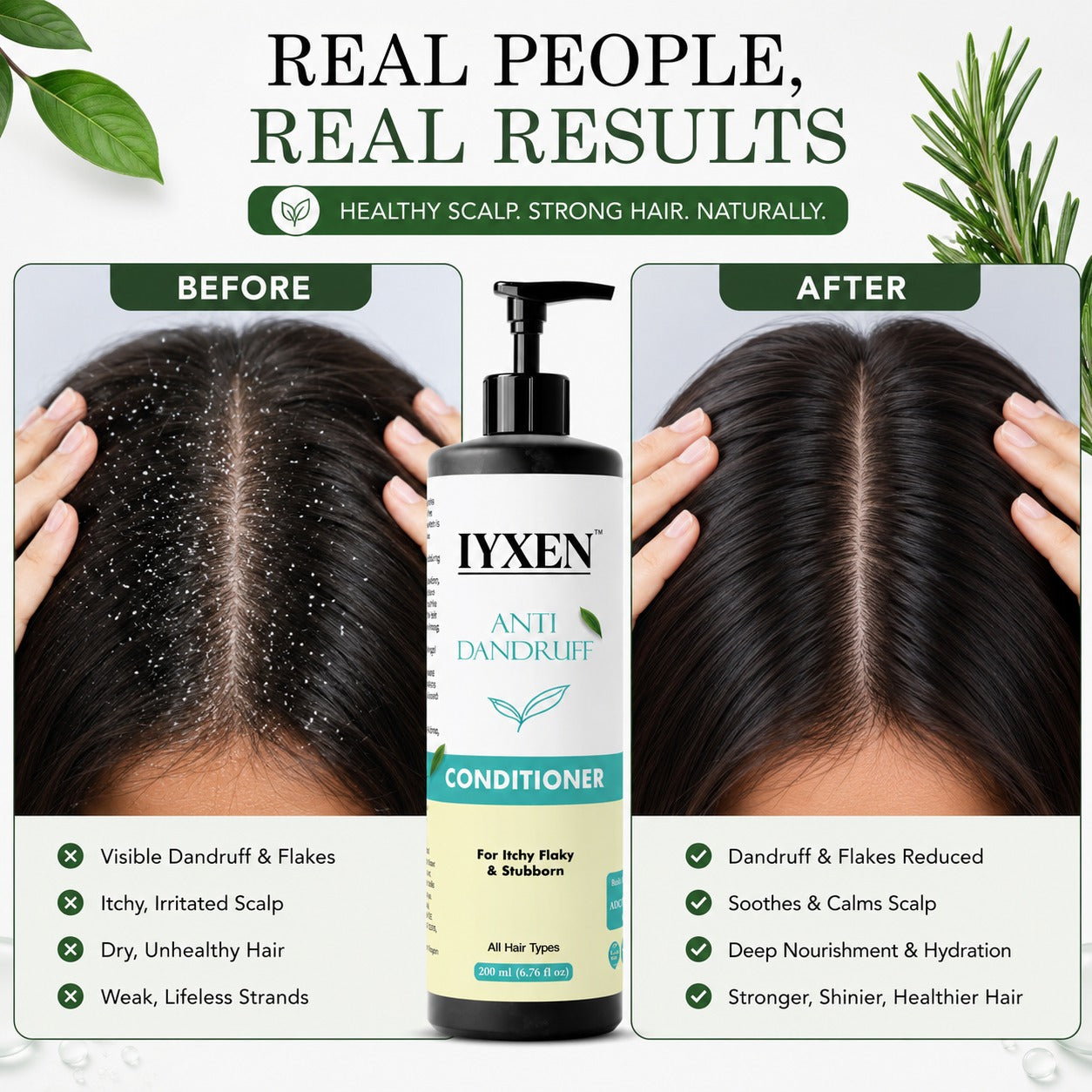 Iyxen Anti Dandruff Conditioner For Itchy Flaky Scalp