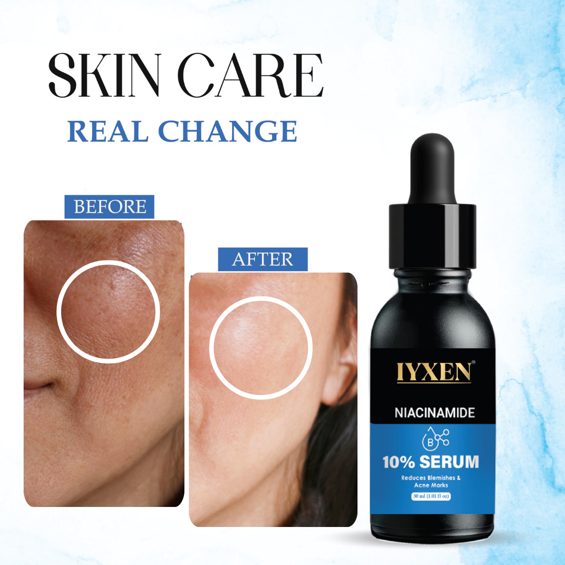 Iyxen Niacinamide 10% Face Serum For Blemishes And Acne Marks
