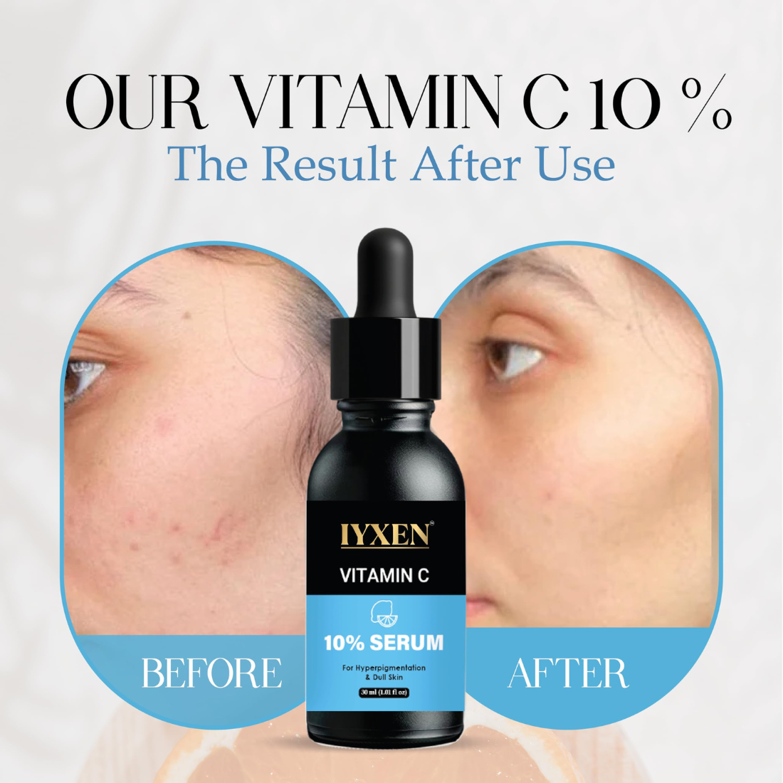 Iyxen Vitamin C 10% Brightening Serum For Hyperpigmentation